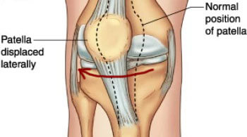 Joint Pain Relief Codes diagram of kneecap and knee pain